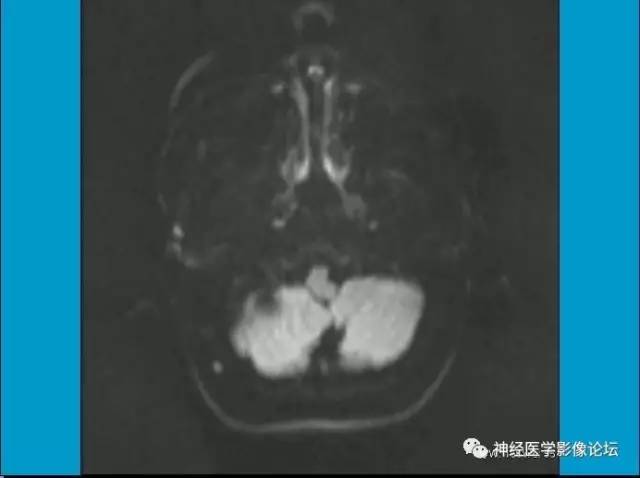 【病例】小脑半球囊性畸胎瘤1例MR