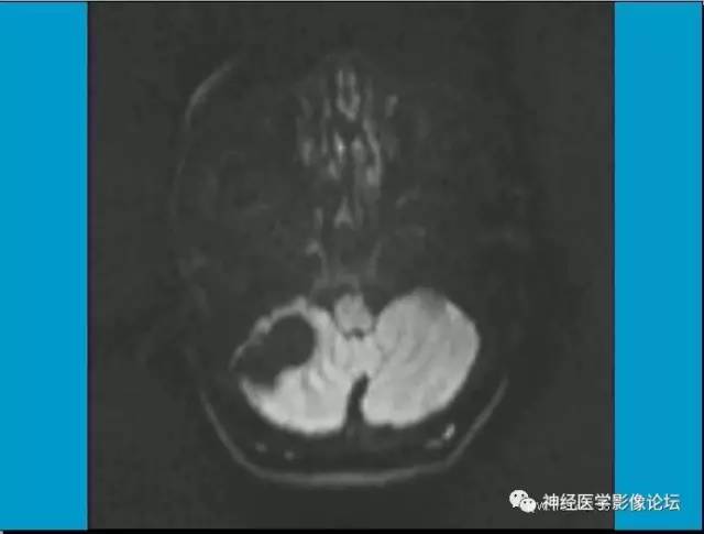 【病例】小脑半球囊性畸胎瘤1例MR