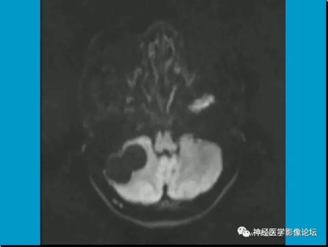 【病例】小脑半球囊性畸胎瘤1例MR