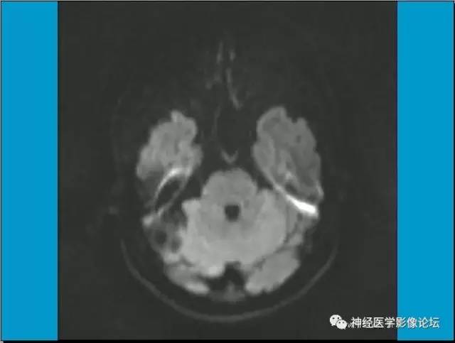 【病例】小脑半球囊性畸胎瘤1例MR