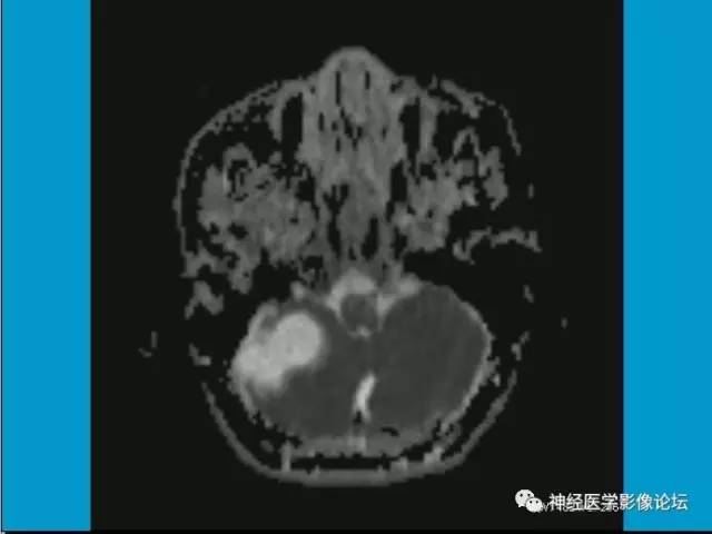 【病例】小脑半球囊性畸胎瘤1例MR