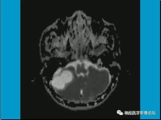 【病例】小脑半球囊性畸胎瘤1例MR