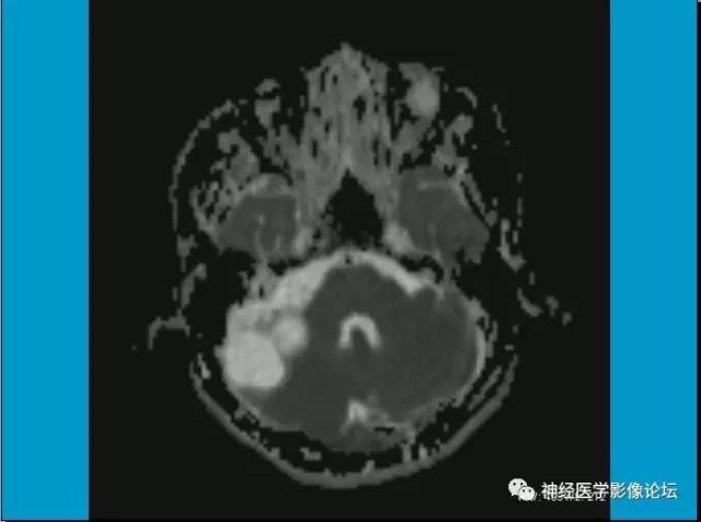 【病例】小脑半球囊性畸胎瘤1例MR
