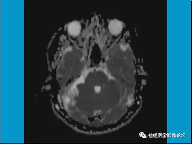 【病例】小脑半球囊性畸胎瘤1例MR