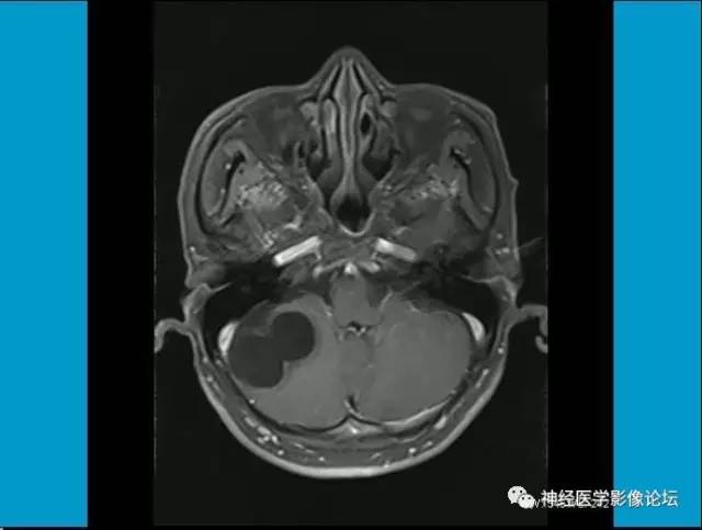 【病例】小脑半球囊性畸胎瘤1例MR