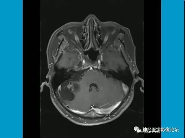 【病例】小脑半球囊性畸胎瘤1例MR