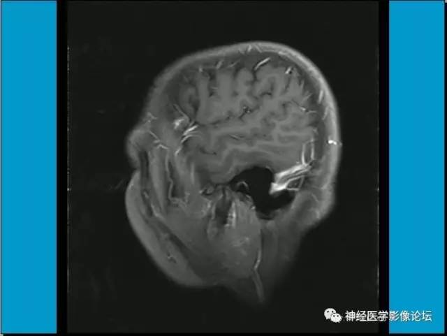 【病例】小脑半球囊性畸胎瘤1例MR