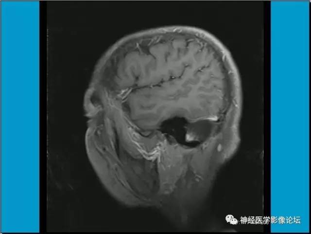 【病例】小脑半球囊性畸胎瘤1例MR