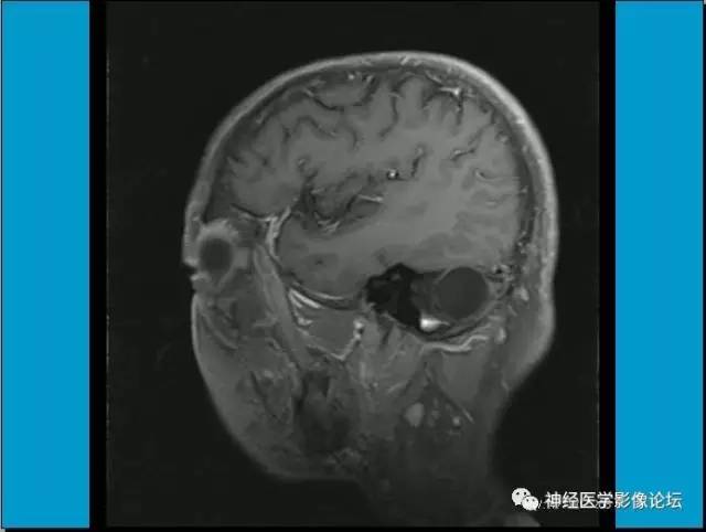 【病例】小脑半球囊性畸胎瘤1例MR