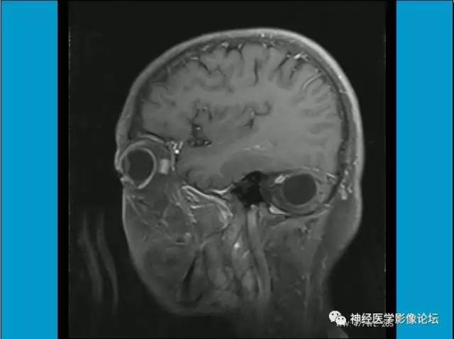 【病例】小脑半球囊性畸胎瘤1例MR