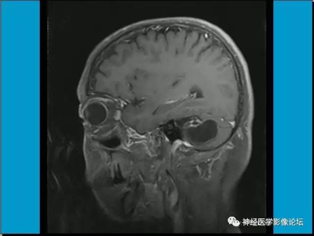 【病例】小脑半球囊性畸胎瘤1例MR