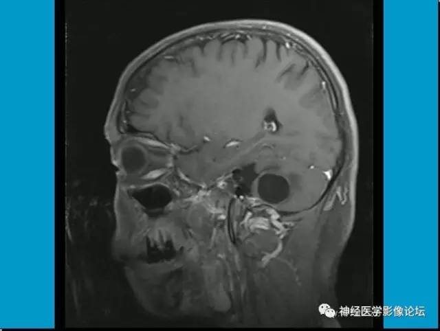 【病例】小脑半球囊性畸胎瘤1例MR