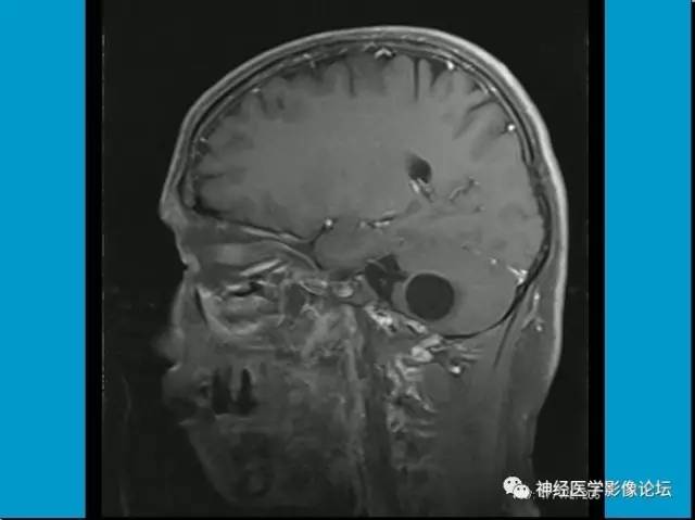 【病例】小脑半球囊性畸胎瘤1例MR