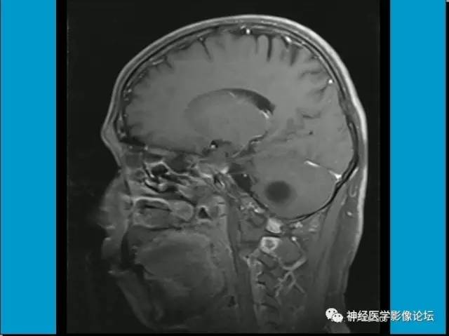 【病例】小脑半球囊性畸胎瘤1例MR