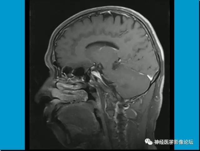 【病例】小脑半球囊性畸胎瘤1例MR