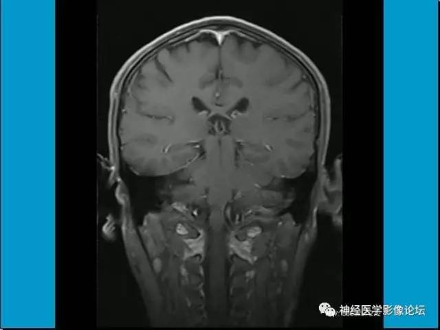 【病例】小脑半球囊性畸胎瘤1例MR
