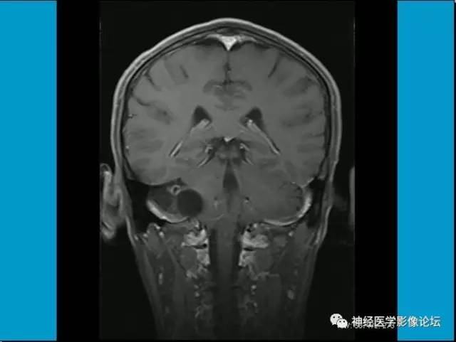 【病例】小脑半球囊性畸胎瘤1例MR