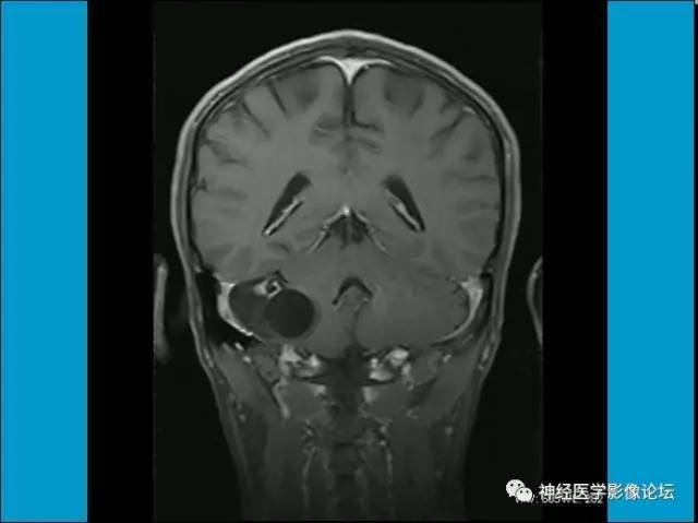 【病例】小脑半球囊性畸胎瘤1例MR