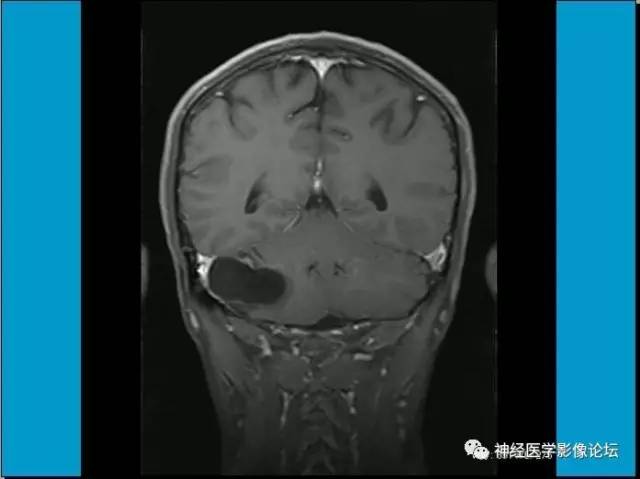 【病例】小脑半球囊性畸胎瘤1例MR