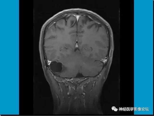 【病例】小脑半球囊性畸胎瘤1例MR