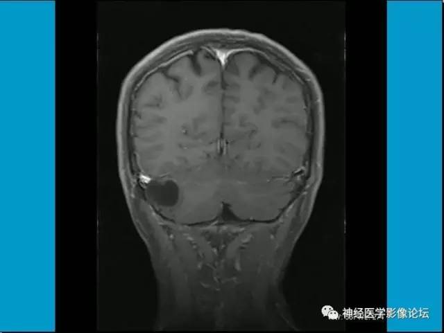 【病例】小脑半球囊性畸胎瘤1例MR