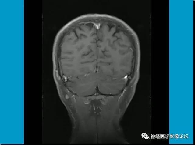 【病例】小脑半球囊性畸胎瘤1例MR