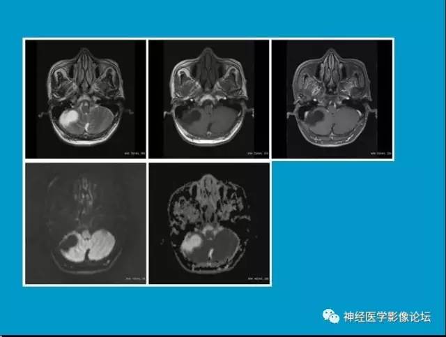 【病例】小脑半球囊性畸胎瘤1例MR