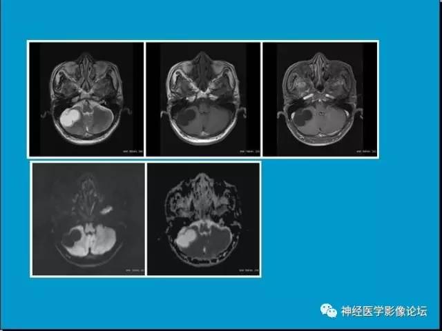 【病例】小脑半球囊性畸胎瘤1例MR