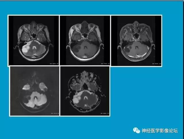 【病例】小脑半球囊性畸胎瘤1例MR