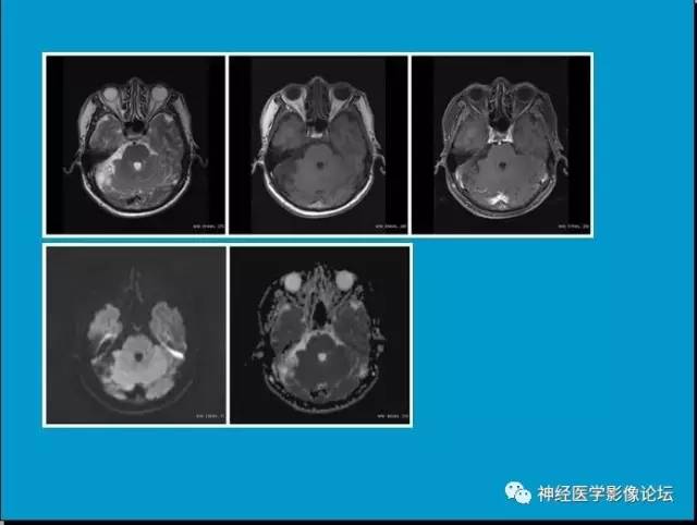 【病例】小脑半球囊性畸胎瘤1例MR