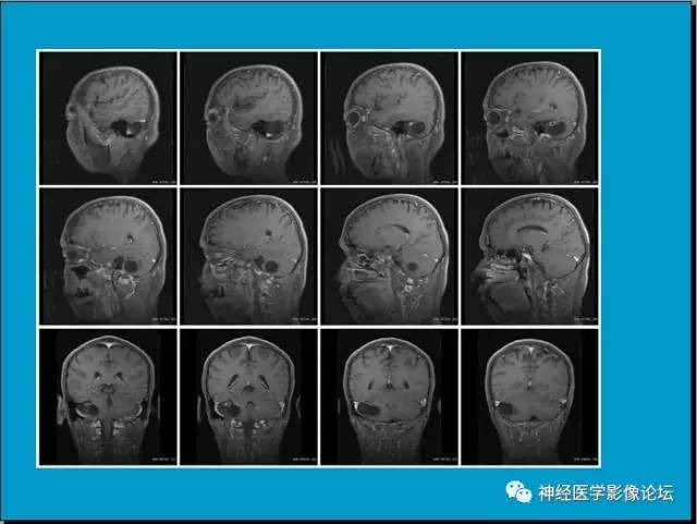 【病例】小脑半球囊性畸胎瘤1例MR
