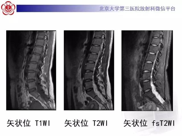 【病例】脊髓栓系综合征1例MR
