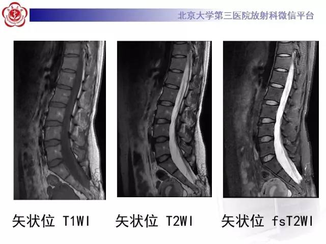 【病例】脊髓栓系综合征1例MR