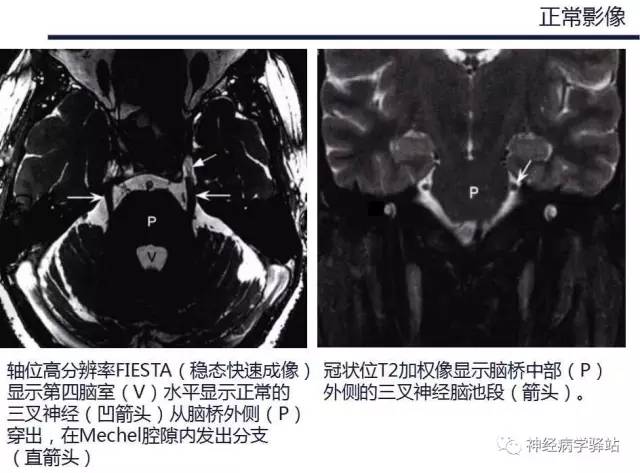 【PPT】三叉神经解剖、影像及临床