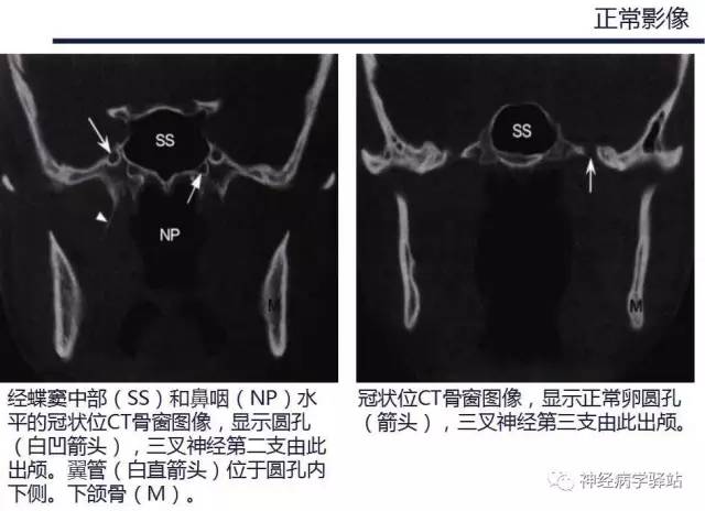 【PPT】三叉神经解剖、影像及临床