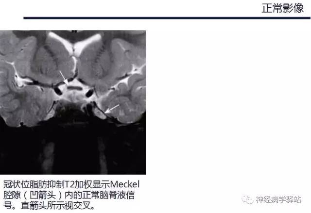 【PPT】三叉神经解剖、影像及临床