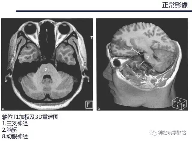 【PPT】三叉神经解剖、影像及临床