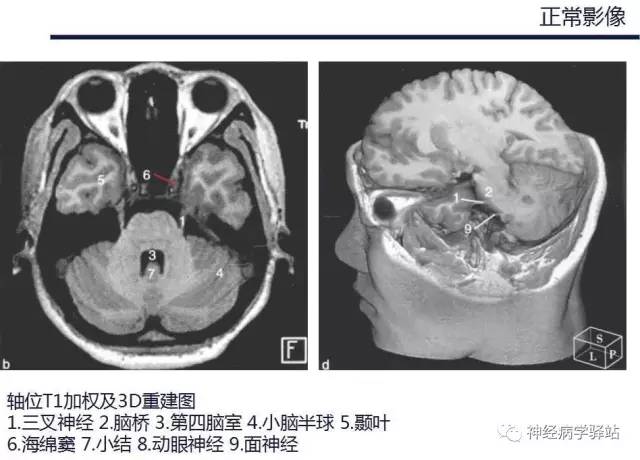 【PPT】三叉神经解剖、影像及临床