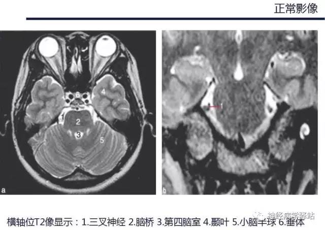 【PPT】三叉神经解剖、影像及临床
