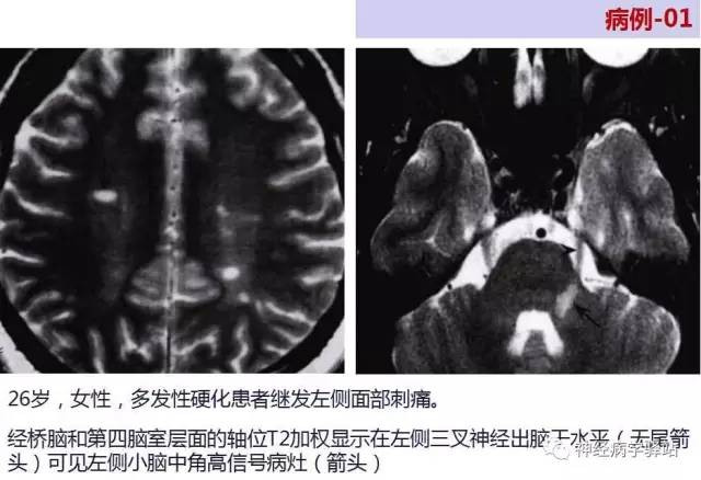 【PPT】三叉神经解剖、影像及临床