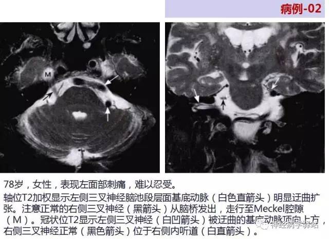 【PPT】三叉神经解剖、影像及临床