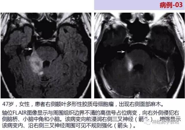 【PPT】三叉神经解剖、影像及临床