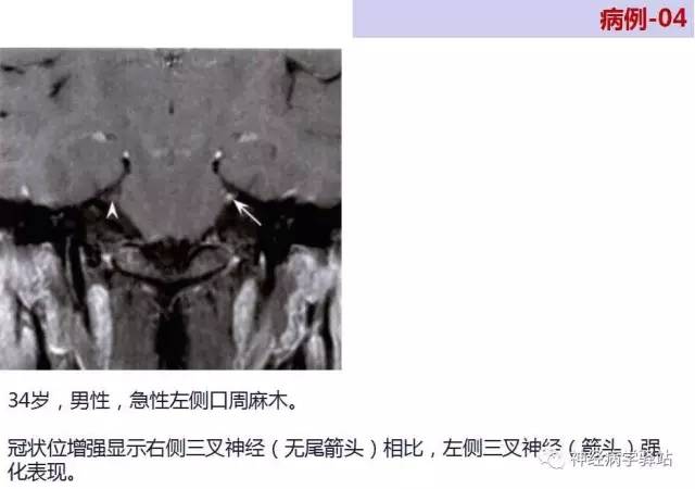 【PPT】三叉神经解剖、影像及临床