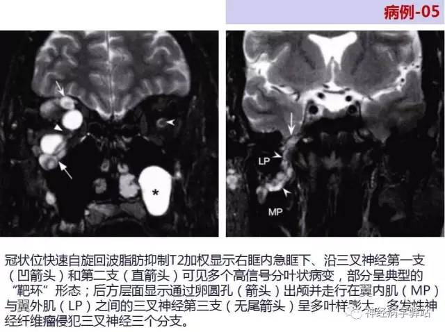 【PPT】三叉神经解剖、影像及临床