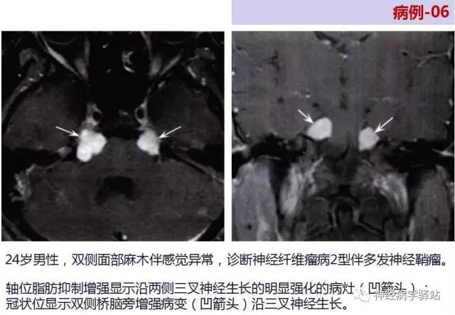【PPT】三叉神经解剖、影像及临床