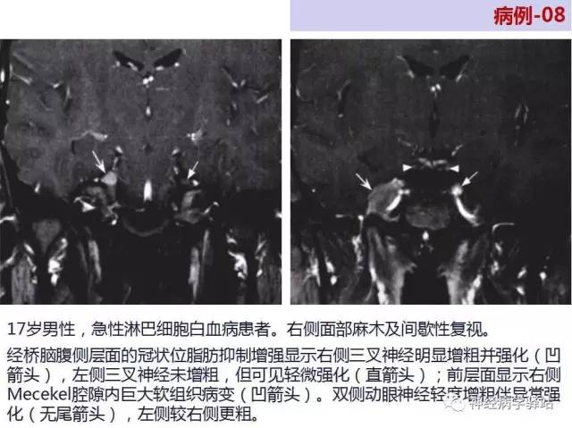 【PPT】三叉神经解剖、影像及临床