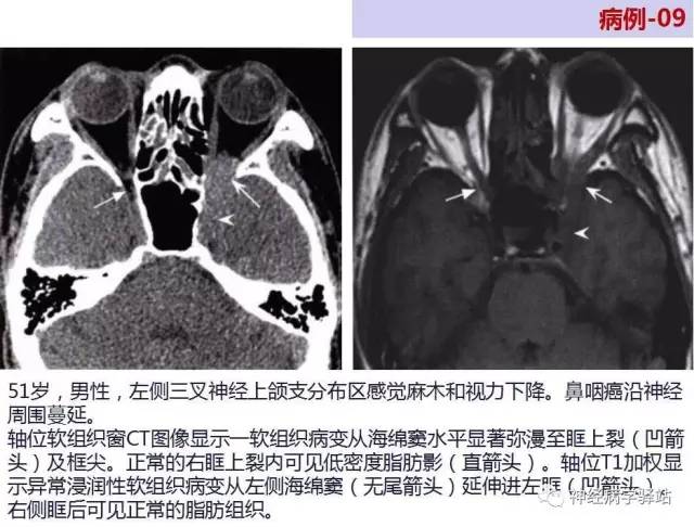 【PPT】三叉神经解剖、影像及临床