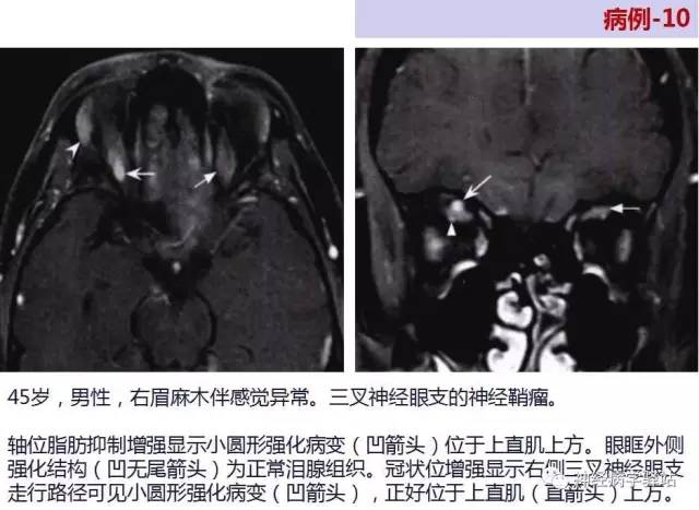 【PPT】三叉神经解剖、影像及临床