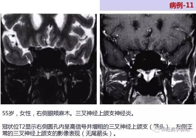 【PPT】三叉神经解剖、影像及临床