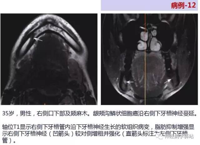 【PPT】三叉神经解剖、影像及临床